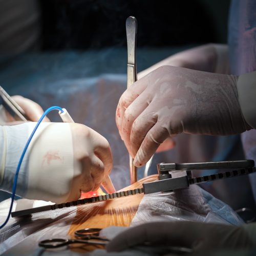 Cirugía de nervios pélvicos