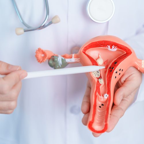 Doctor holding Uterus and Ovaries model. Ovarian and Cervical ca Ginecología oncológica