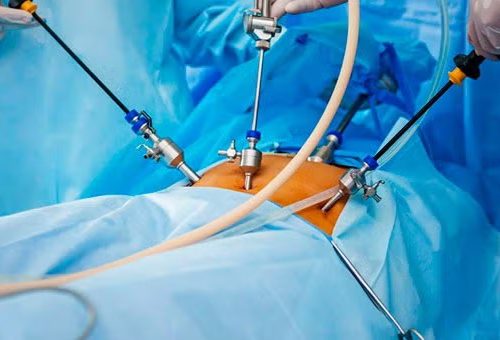 laparoscópica copia Cirugía Laparoscópica