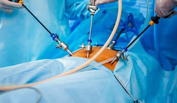 Cirugía Laparoscópica